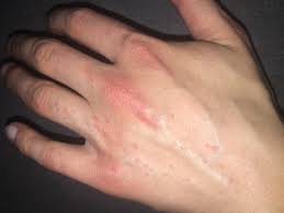 Auf Der Hand Risse Und Rote Punkte Ausschlag Mit Bild Was Ist Das Und Wie Bekomme Ich Es Weg Gesundheit Medizin Krankheit