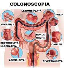 Totul Despre Boala Crohn Tratament Naturisttratament Naturist