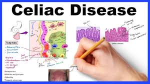 Renée moerkens and joram mooiweer. Celiac Disease Pathophysiology Symptoms Histology Diagnosis Management Youtube