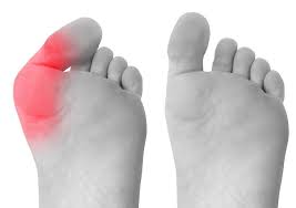 Minimally invasive techniques can easily treat bunions but it can be done only for mild to moderately painful bunions. How Minimally Invasive Surgery Can Help Treat Your Bunion Progressive Podiatry Pllc Podiatrists