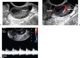 Image result for corpus luteum sonography)