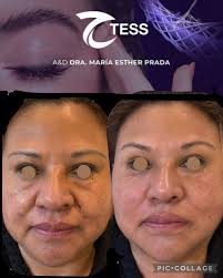 draprada #dramaiteprada #tess #nonsurgicalfacelift #noquirurgico  #rejuvenecimiento #belleza #tesslift