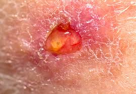 **if a shave biopsy was done, the wound will take as long as a scraped knee to heal. Why You Should Never Ignore Leg Sores That Won T Heal Health Essentials From Cleveland Clinic