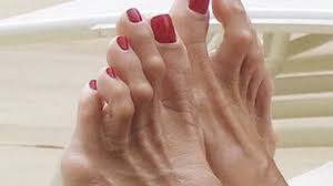 How you fix mallet toe will depend when your foot goes a long time without getting wet, it can get scaly and dry. Minimally Invasive Hammertoe Surgery The Bunion Cure