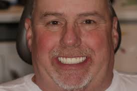 Advantages of ArchONE's Full Arch Implant System