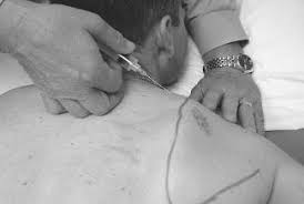 Image result for Scapulothoracic Injection