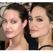 ¿qué cirugía plástica deberías hacerte a pesar del dolor y el sufrimiento? 27 Ideas De Rinoplastia Y Bachectomia Rinoplastia Bichectomia Cirugia Estetica