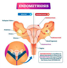 How to get tested for endometriosis. Endometriosis Treatment Nyc Pelvic Pain Specialist In New York City