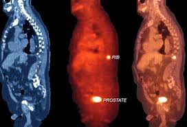 Symptoms depend on the size of new growth and where the cancer has spread in the body. Prostate Cancer Symptoms Pca Test Treatments