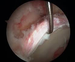 Image result for Hip Labral Tear