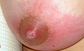 Milchstau Mastitis Und Abszess