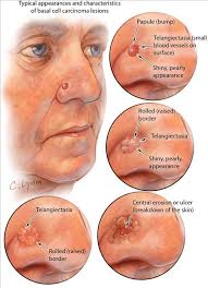 Skin Sun Damage Birthmarks And Mole Removal In St Louis Llav Dermatology Nurse Basal Cell Carcinoma Basal Cell