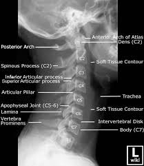 Cervical Spine Radiographic Anatomy Wikiradiography Radiology Student Radiology Schools Medical Anatomy