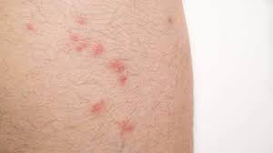 Maybe you would like to learn more about one of these? How To Get Rid Of Fleas Stuff Co Nz
