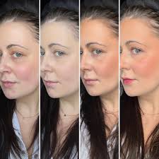 Comparison of face lift costs and alternatives