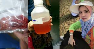 Fibroid di kalangan wanita yang agak kerap. Berat Dugaan Wanita Ini Setelah 2 Minggu Disahkan Ovarian Cyst Hidap Kanser Rahim Pula Terpaksa Dibuang Hijabista