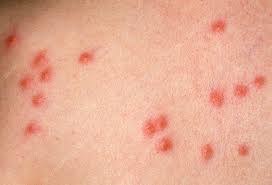 Image result for flea bites