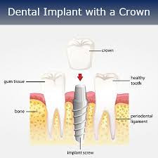 Maybe you would like to learn more about one of these? Dentist Glendale Dental Implant Crown Types Smile Makeover Of La
