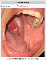Image result for Tonsillolith