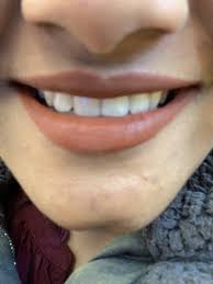 Braces are one of the most well known ways to fix crooked teeth and there are two different. Braces With Extractions Have Ruined My Smile How Do I Undo This Photos