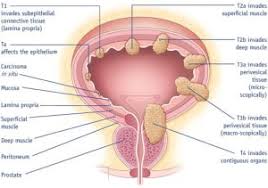 It's one of the deadliest types of cancer for women in the united states, second only to lung cancer. Bladder Cancer Treatment Cost In India Top 10 Cancer Hospitals In India