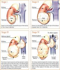Pin On Kidney Cancer