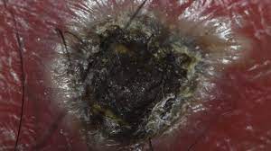 Eschara) is a slough or piece of dead tissue that is cast off from the surface of the skin, particularly after a burn injury, but also seen in gangrene, ulcer, fungal infections, necrotizing spider bite wounds, tick bites associated with spotted fevers, and exposure to cutaneous anthrax. Eschar Causes Diagnosis And Treatment