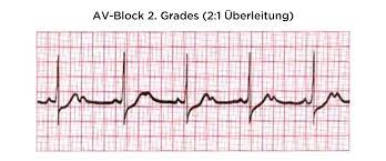Av Block Deximed