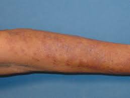 Image result for Photodermatitis