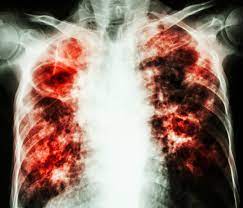 This widespread form of tb disease, called disseminated tb or miliary tb, occurs most commonly in the very young, the very old and those with hiv infections. The Fight Against Tb Shifts To Fixing The Immune System Not Only Bacteria