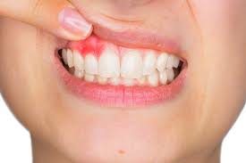 How To Stop Receding Gums Desai Dental