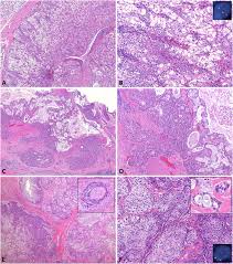 By grading you will have an idea. Mucoepidermoid Carcinoma A Comparison Of Histologic Grading Systems And Relationship To Maml2 Rearrangement And Prognosis Abstract Europe Pmc