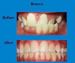 Braces are becoming more and more common as we try to hide our flaws. Adult Braces How To Know If You Really Need Them True Image Orthodontics