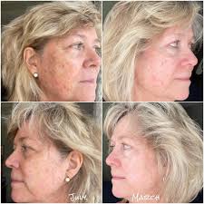 Tuesday Testimonial ~ Here is Michelle's story.... This isn't  skincare.....It's SkinREPAIR!!!!! "I am proof, at 68, it is never too late  to heal your skin and obtain a healthy glow I have