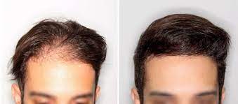Tratamiento Para Recuperar El Cabello Perdido Caso Antes Despues