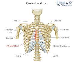 This is an important landmark, as the second costal cartilage is attached to it laterally, and. Costochondritis Rehab My Patient