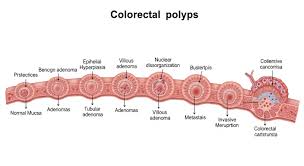 Image result for Colonic Polyp