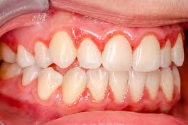 Image result for Gingivitis