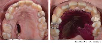 Mucormicosis rinocerebral asociada a agranulocitosis más diabetes mellitus: Paciente Endodontico Con Mucormicosis Rinocerebral Reporte De Un Caso1 Revista Odontologica Mexicana