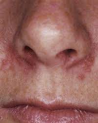 Contentious Rhinosinusitis Symptoms May Include A Rash Around The Nose Or Mouth Areas Perioral Dermatitis Dermatitis Treatment Rash On Face