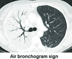 Image result for Air Bronchogram