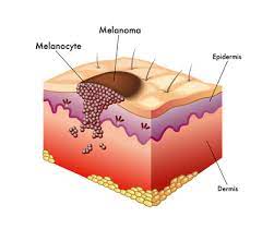 Skin cancer is the typical type of cancer among all cancer types, in which changes will start appearing on the skin, mainly a new growth or a pain that will not heal. Skin Cancer In Children Curesearch