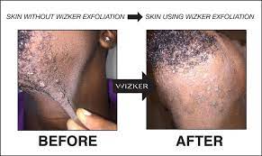 As their name suggests, these stubborn lumps form when a hair grows back into the skin. Wizker Brush Testimonials Wizker The 1 Bump Fighting Exfoliating Ingrown Hair Brush