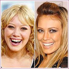 And endured pneumonia and plastic surgery in later life which . Celebrity Plastic Surgery Before After 56 Pics Izispicy Com