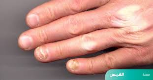 انحلال الأظافر».. كيف نعالجه ومتى يصبح خطراً؟