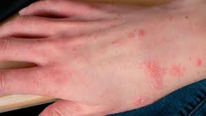 Image result for scabies effects on the human body