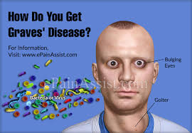 Jan 18, 2021 · what is graves' disease? How Do You Get Graves Disease