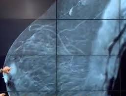 De aceea este foarte important de stiut ce stadiu are cancerul tau. Cancerul De San 2017 Centru Oncologie Severin