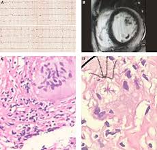 Although these categories extend the definition of myocarditis beyond the narrow. Giant Cell Myocarditis Case Review Multidisciplinary Cardiovascular Annals Full Text