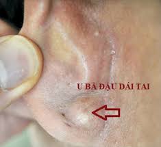 Dái tai bị sưng: nguyên nhân và cách điều trị